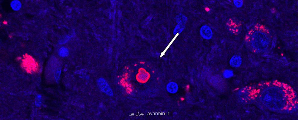 رازگشایی علم ژنتیک از نادرترین بیماری عصبی
